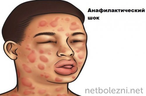 Anaphylactic shock after a vaccine