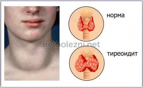 Autoimmune disease Thyroiditis