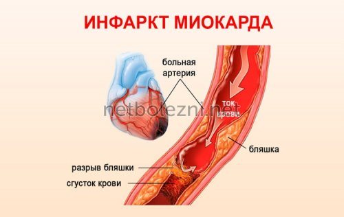 Болезнь инфаркт миокарда