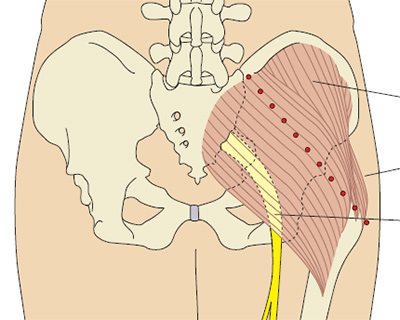 Gluteus maximus muscle: sites for intramuscular injections