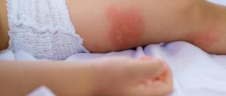 бывает ли аллергия после прививки