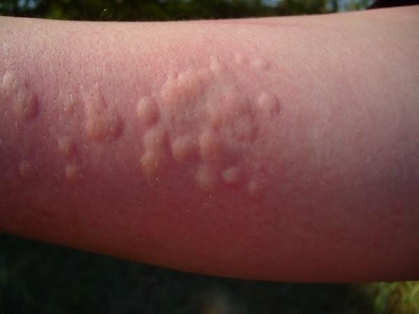 бывает ли аллергия при манту или диаскинтесте