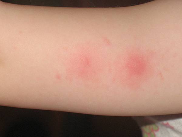 &#39;How to explain the swelling and redness of the skin after vaccination? 