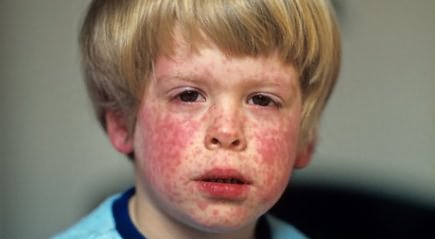 What can measles cause?