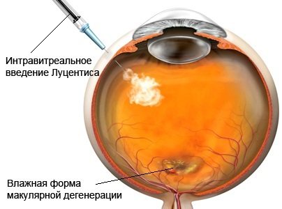 Intravitreal administration of Lucentis