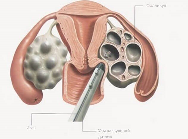 How is the follicle puncture procedure performed during IVF?