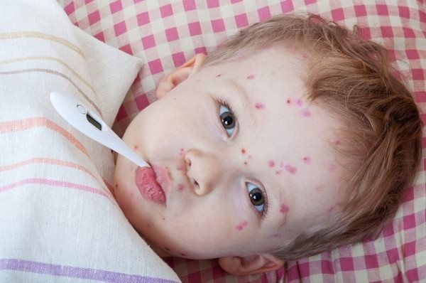 Measles in the fifth year and a rash in a boy