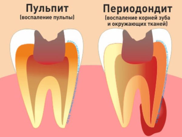 Periodontitis of the tooth