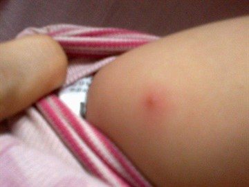 Swelling after DTP vaccination: what to do, advice from doctors