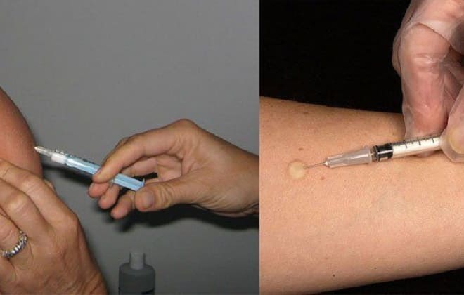 BCG vaccination and Mantoux test, respectively