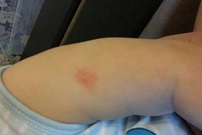 BCG vaccination turned red
