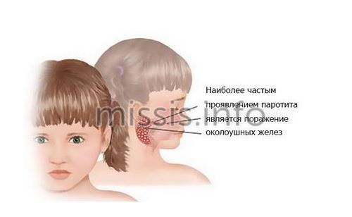 Manifestation of mumps in children