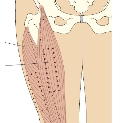 Прямая мышца бедра и латеральная головка четырехглавой мышцы бедра: места для внутримышечных инъекций