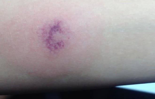 Bruise at the site of the mantoux test