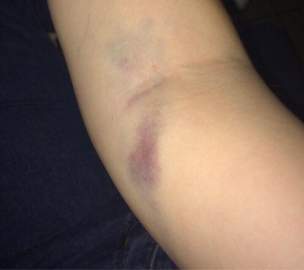 Bruise after injection