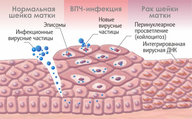 Spectrum of changes in the end-to-end epithelium.jpg
