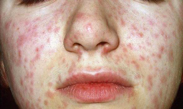 Rash caused by measles virus