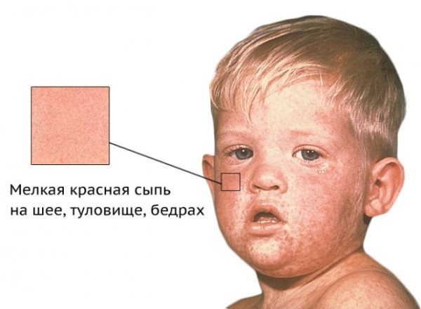 Rash as a complication after vaccination