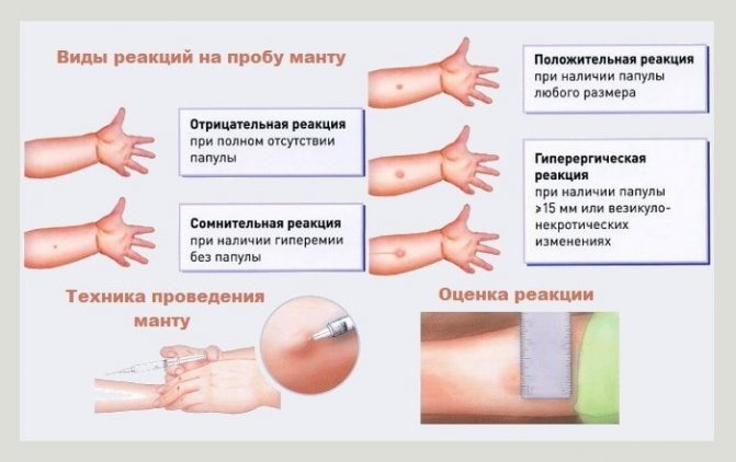 Types of reactions to the mantoux test