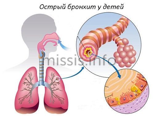 The occurrence of bronchitis in children